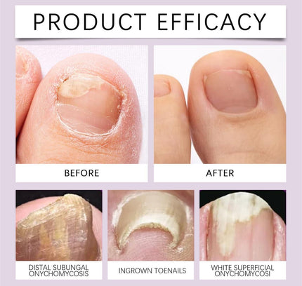 Bee Venom Nail Treatment Solution Serum – 15 ml